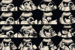 Sixteen ultrasound images of a fetus.